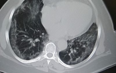 How to deal with post-Covid Lung Fibrosis?