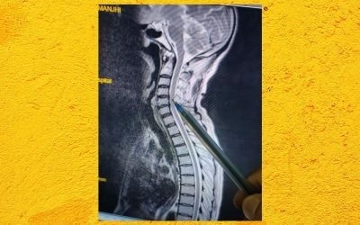 Is it MND or Cervical Cord Compression?