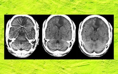 Young Doctor with Recurrent Stroke: A Diagnostic and Therapeutic Dilemma.