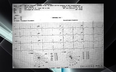 A young patient presented with acute onset LMN type of quadriparesis. Other vitals are WNL.