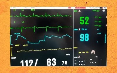 What kind of heart block is going on?