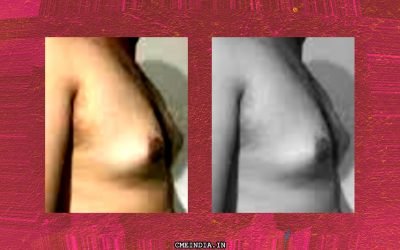 Married 32 yr. old male referred for Erectile Dysfunction