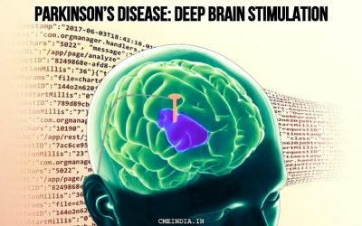 Parkinson’s disease: Deep Brain Stimulation – when needed?