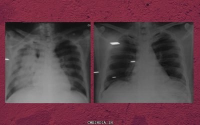 Right Lung Massive Opacity, SOB, Pyrexia and Raised Count: What could it be?