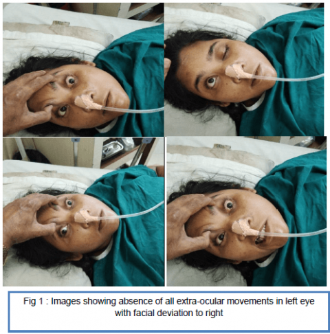 Multiple Cranial Nerve Palsy in A Non-Covid Case - CME INDIA