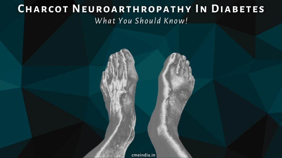 Charcot Neuroarthropathy In Diabetes: What You Should Know!