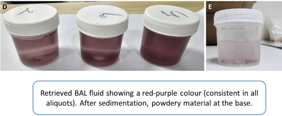 A Curious Case of Hemoptysis - Thinking Out of The Box