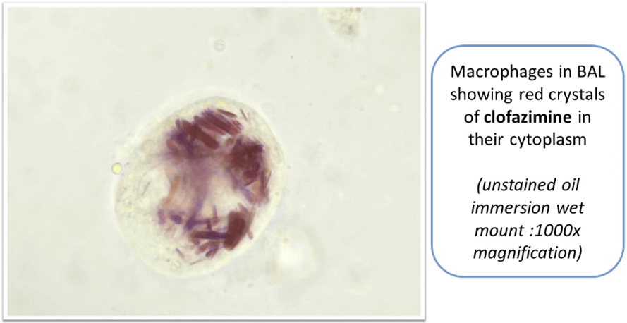 A Curious Case of Hemoptysis - Thinking Out of The Box