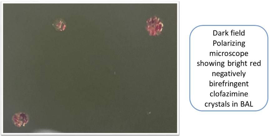 A Curious Case of Hemoptysis - Thinking Out of The Box