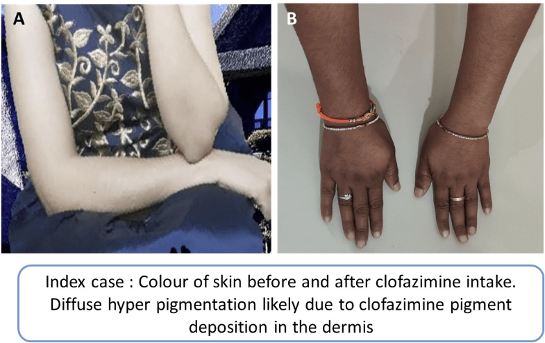 A Curious Case of Hemoptysis - Thinking Out of The Box