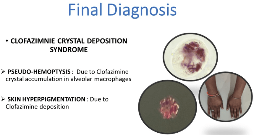 A Curious Case of Hemoptysis - Thinking Out of The Box