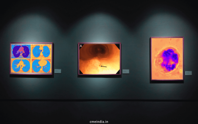 A Curious Case of Hemoptysis – Thinking Out of The Box