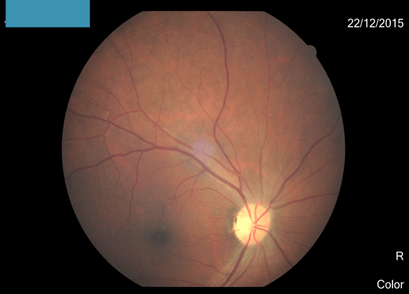 Myelin Oligodendrocyte Glycoprotein (MOG) Associated Disorders - What Physicians Must Know?