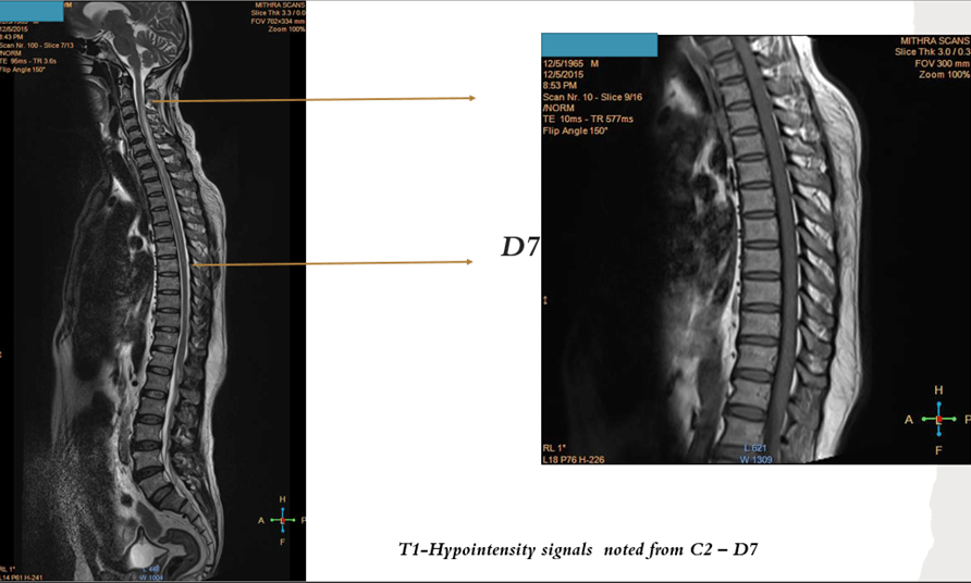 Myelin Oligodendrocyte Glycoprotein (MOG) Associated Disorders - What Physicians Must Know?