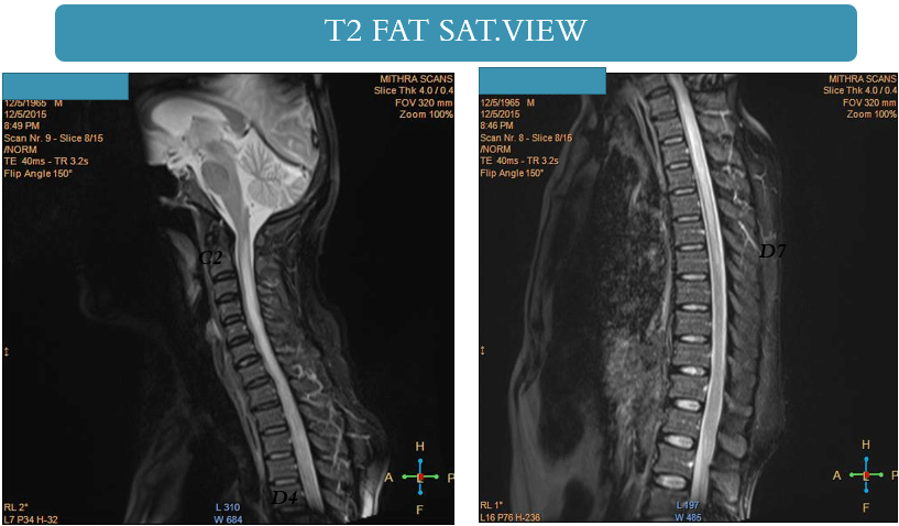 Myelin Oligodendrocyte Glycoprotein (MOG) Associated Disorders - What Physicians Must Know?