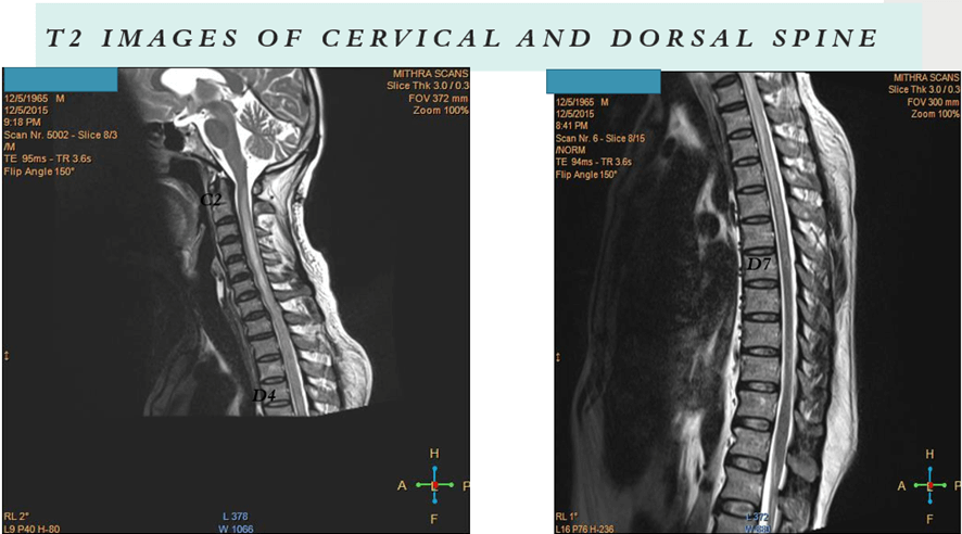 Myelin Oligodendrocyte Glycoprotein (MOG) Associated Disorders - What Physicians Must Know?
