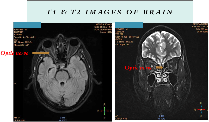 Myelin Oligodendrocyte Glycoprotein (MOG) Associated Disorders - What Physicians Must Know?