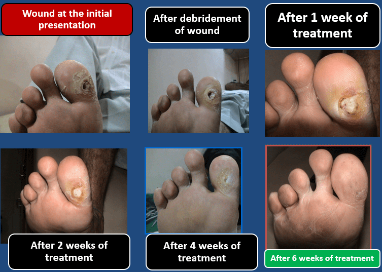 What Physicians Need to Advice Patients About Diabetic Foot Care?