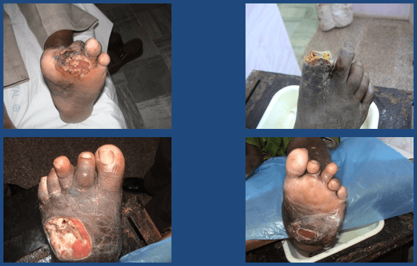 What Physicians Need to Advice Patients About Diabetic Foot Care?