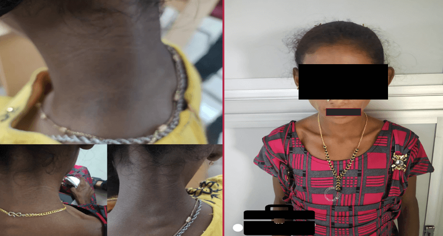 Recurrent Abdominal Pain and Elevated Triglycerides in a 15-year-old Diabetic Patient