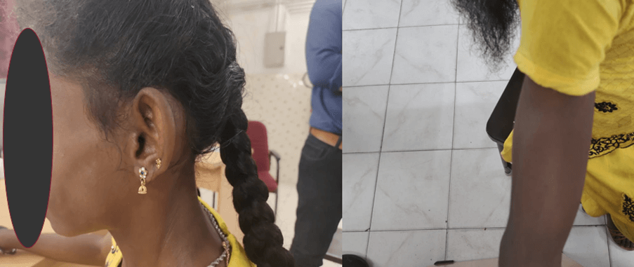 Recurrent Abdominal Pain and Elevated Triglycerides in a 15-year-old Diabetic Patient