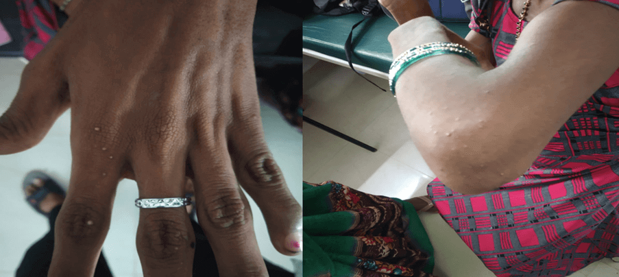 Recurrent Abdominal Pain and Elevated Triglycerides in a 15-year-old Diabetic Patient