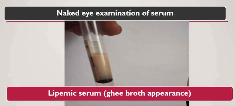 Recurrent Abdominal Pain and Elevated Triglycerides in a 15-year-old Diabetic Patient