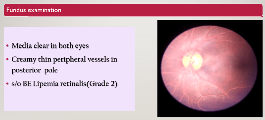 Recurrent Abdominal Pain and Elevated Triglycerides in a 15-year-old Diabetic Patient