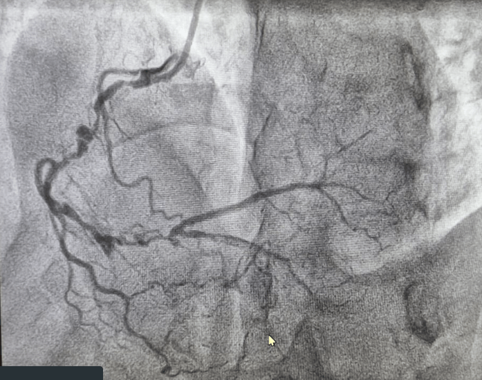 Puzzle: 42 Yr. Old Male Patient with Left Sided Chest Pain of 1 Day Duration