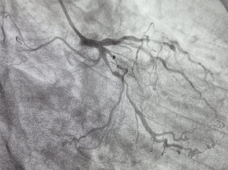 Puzzle: 42 Yr. Old Male Patient with Left Sided Chest Pain of 1 Day Duration