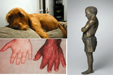 Atypical Diabetes, Why Do We Miss It?