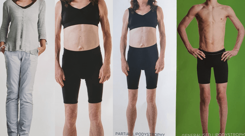 Atypical Diabetes, Why Do We Miss It?