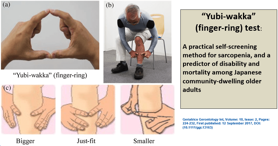 Sarcopenic Obesity: Simplified