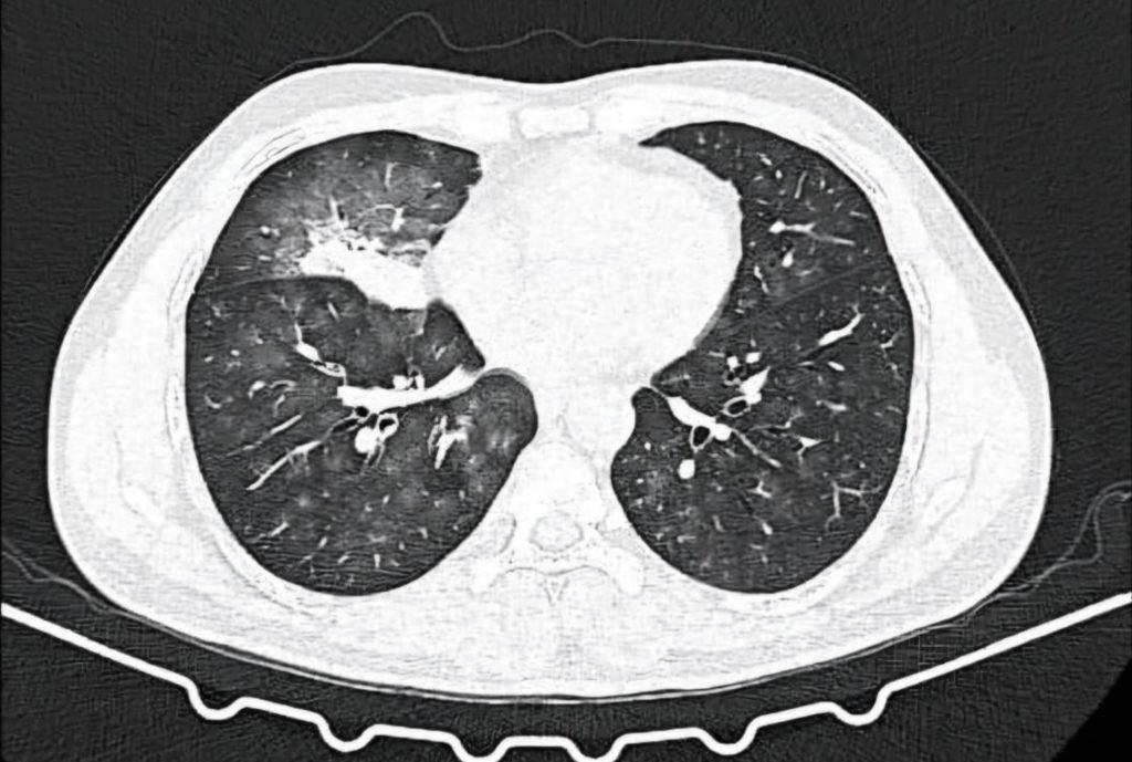There is always a way; if there isn't, make one! - IP (Interstitial Pulmonary diseases) beyond barriers