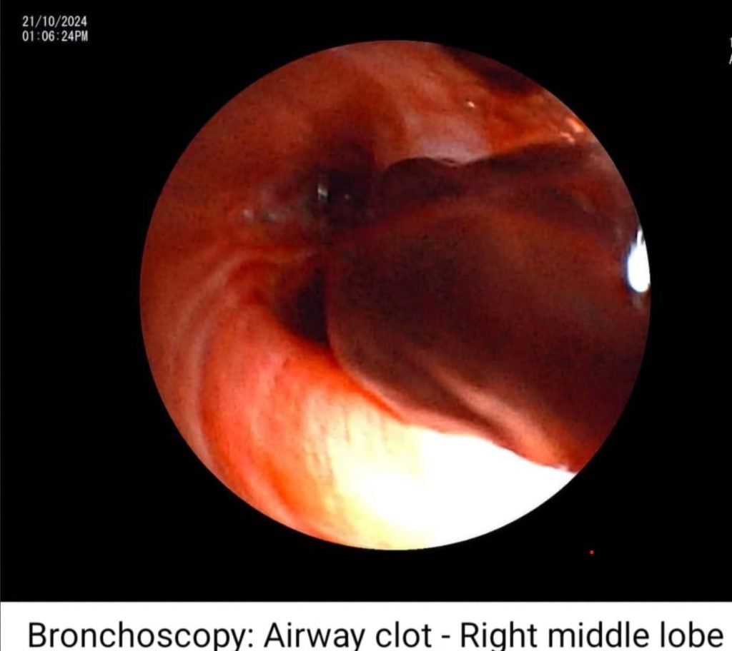 There is always a way; if there isn't, make one! - IP (Interstitial Pulmonary diseases) beyond barriers 