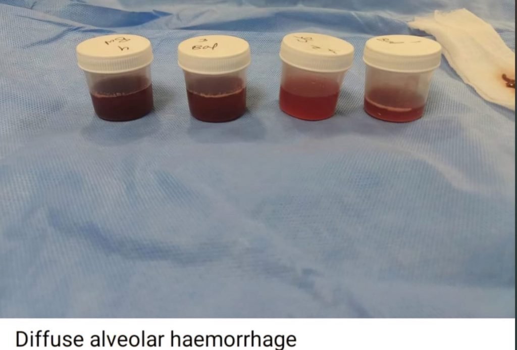 There is always a way; if there isn't, make one! - IP (Interstitial Pulmonary diseases) beyond barriers