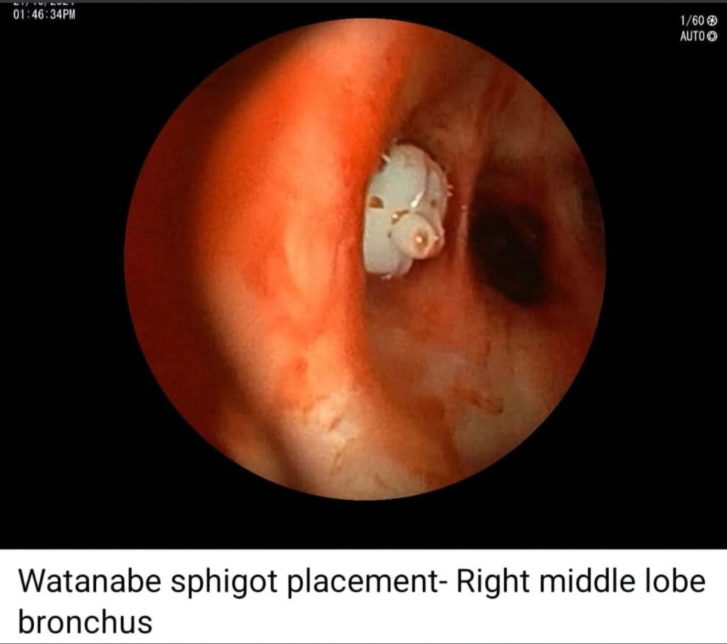 There is always a way; if there isn't, make one! - IP (Interstitial Pulmonary diseases) beyond barriers