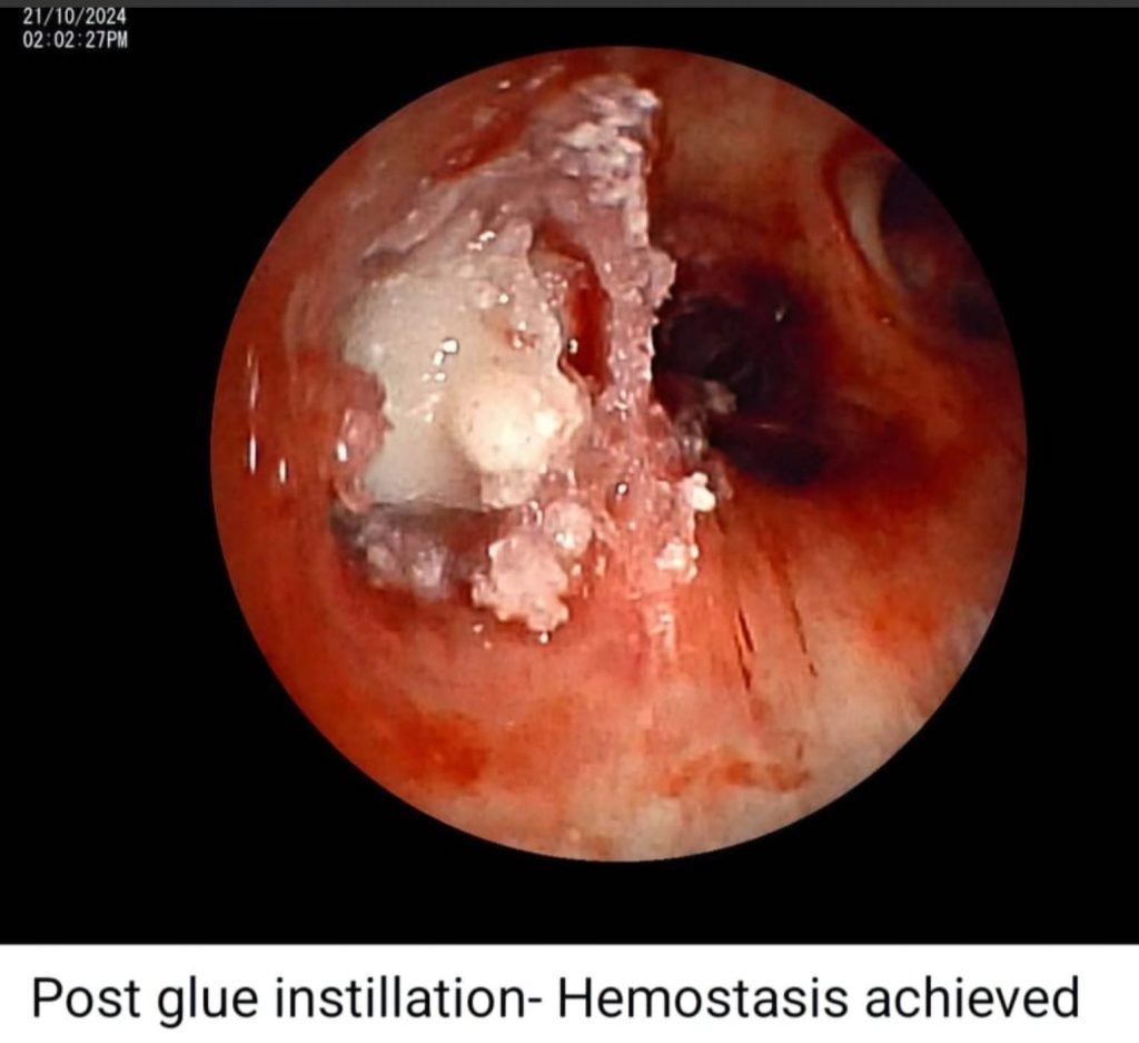 There is always a way; if there isn't, make one! - IP (Interstitial Pulmonary diseases) beyond barriers