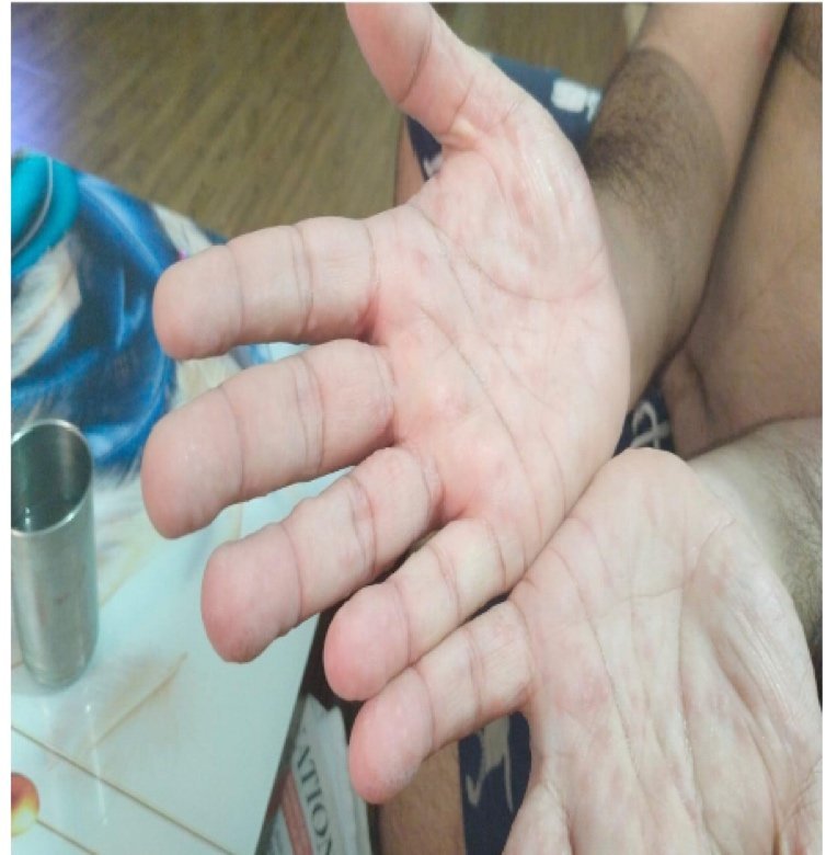 22-year-old male with a sudden onset of fever and petechial skin lesion