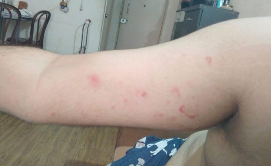 22-year-old male with a sudden onset of fever and petechial skin lesion