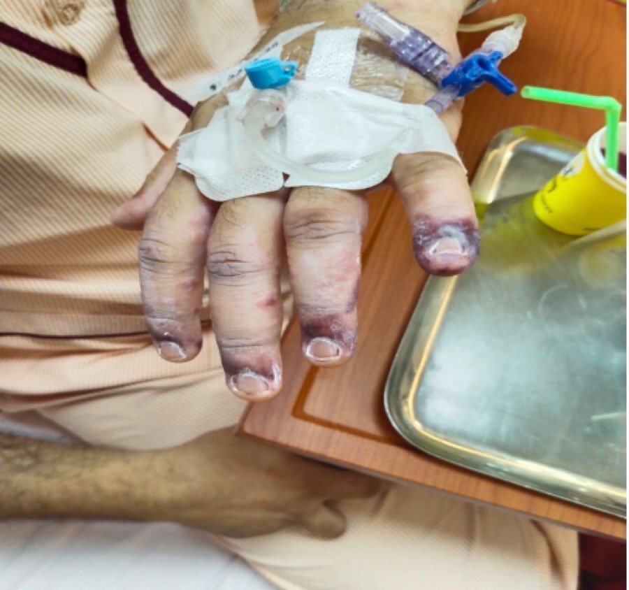 22-year-old male with a sudden onset of fever and petechial skin lesion