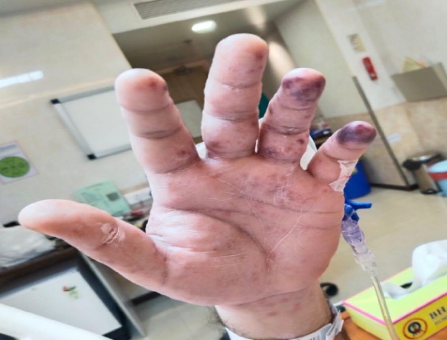 22-year-old male with a sudden onset of fever and petechial skin lesion