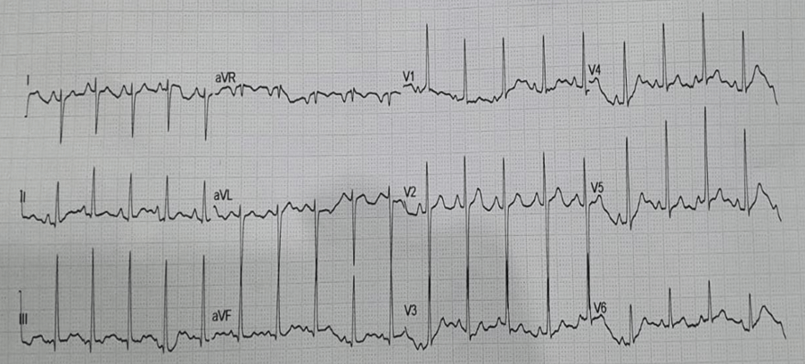 Tetralogy Of Fallot with Pulmonary Hyperemia