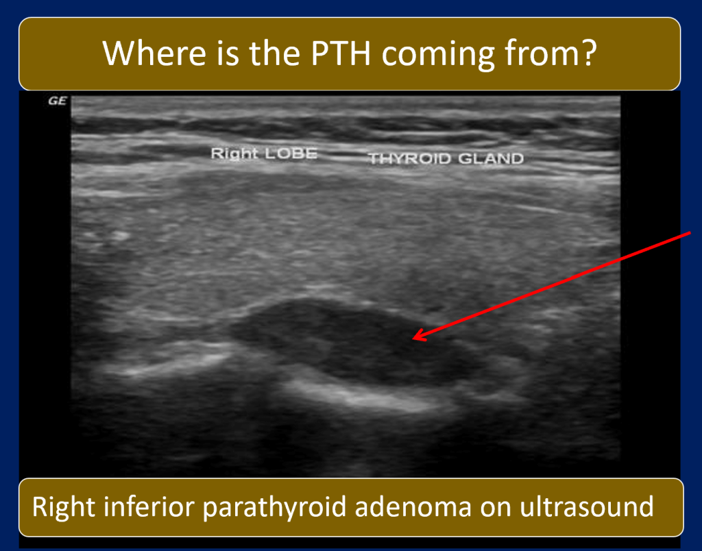 What Physicians Must Know about Approach to Recurrent Renal Calculi