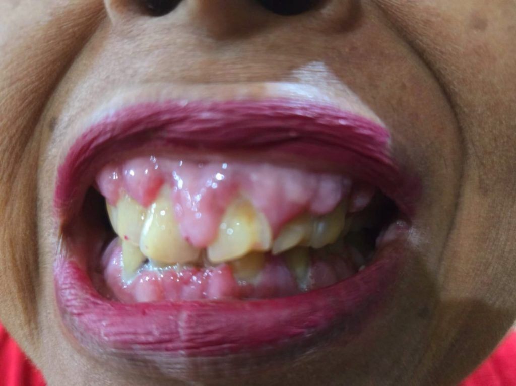 Was Gingival Hypertrophy Induced by Vildagliptin?
