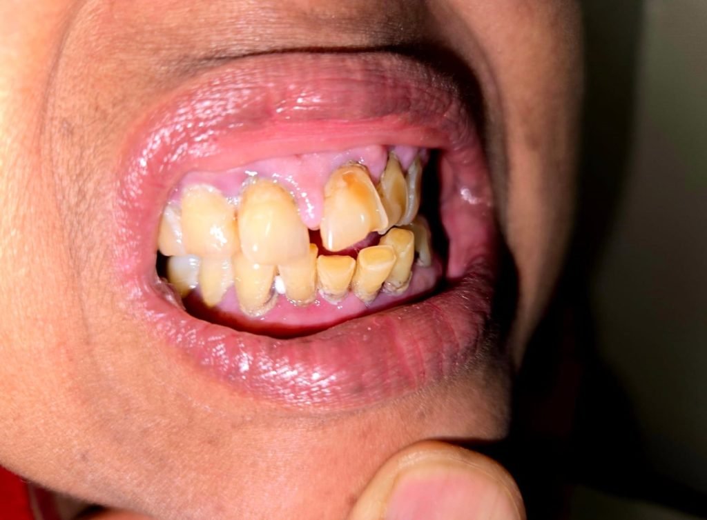 Was Gingival Hypertrophy Induced by Vildagliptin?