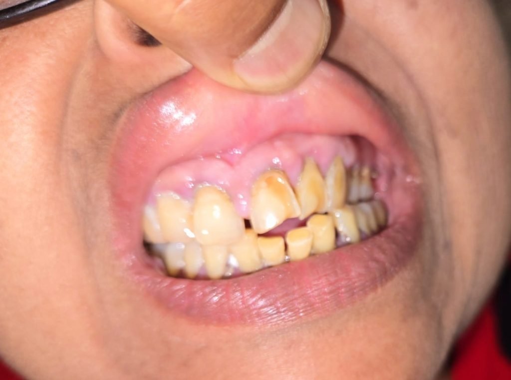 Was Gingival Hypertrophy Induced by Vildagliptin?