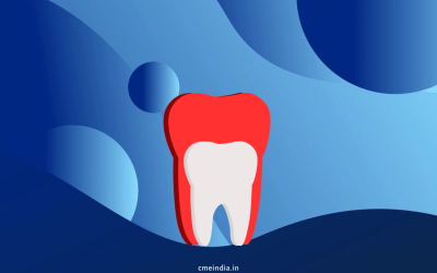 Was Gingival Hypertrophy Induced by Vildagliptin?