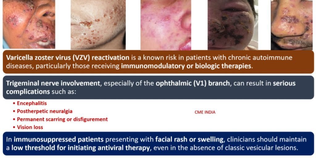 Uncommon presentation of the herpes zoster (shingles) along the maxillary division (V2) of the trigeminal nerve in a controlled T2DM