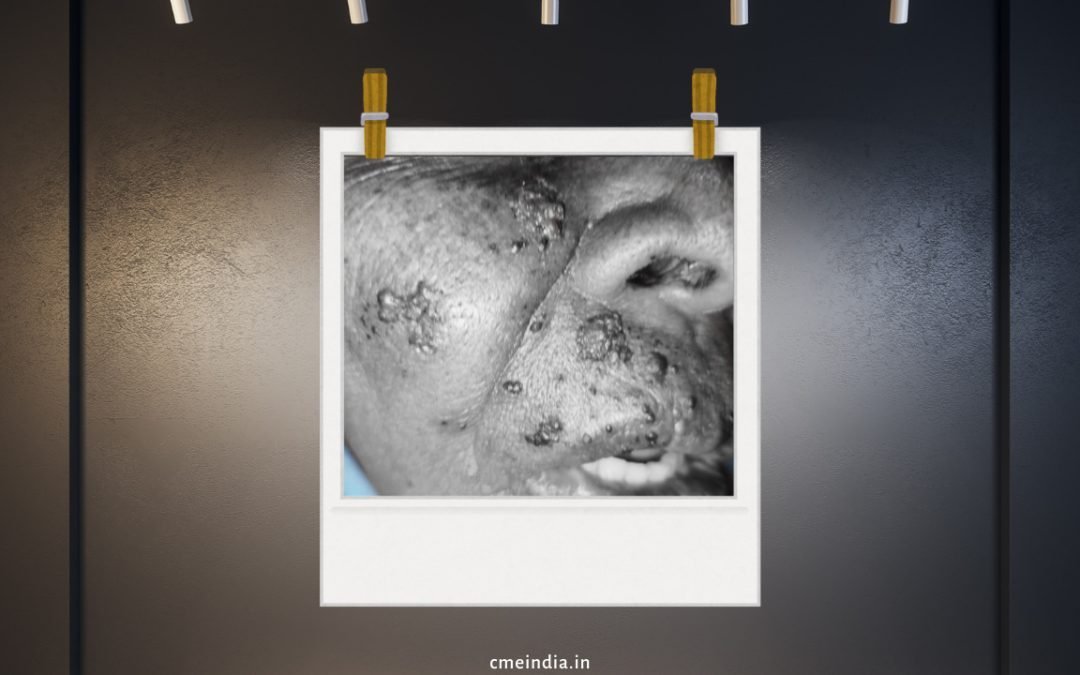 Uncommon presentation of the herpes zoster (shingles) along the maxillary division (V2) of the trigeminal nerve in a controlled T2DM
